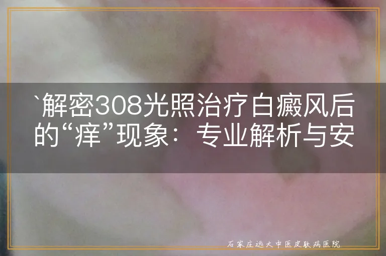 解密308光照治疗白癜风后的“痒”现象：专业解析与安心指南