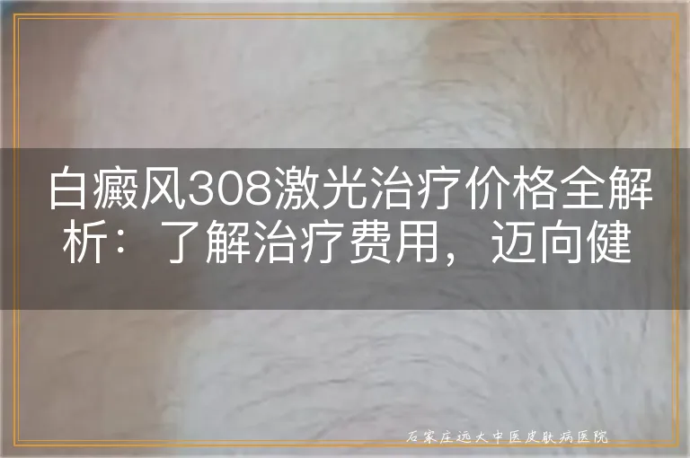 白癜风308激光治疗价格全解析：了解治疗费用，迈向健康肌肤