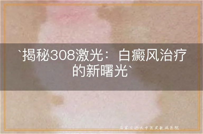 揭秘308激光：白癜风治疗的新曙光