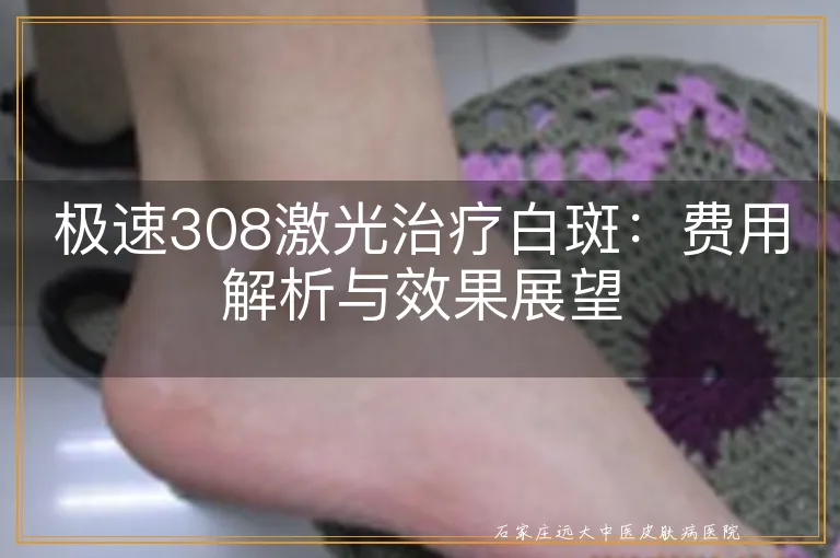 极速308激光治疗白斑：费用解析与效果展望