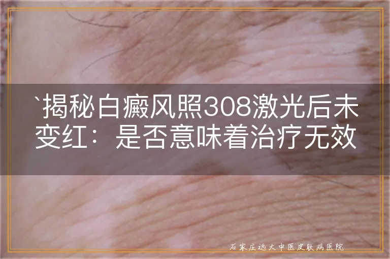 揭秘白癜风照308激光后未变红：是否意味着治疗无效？