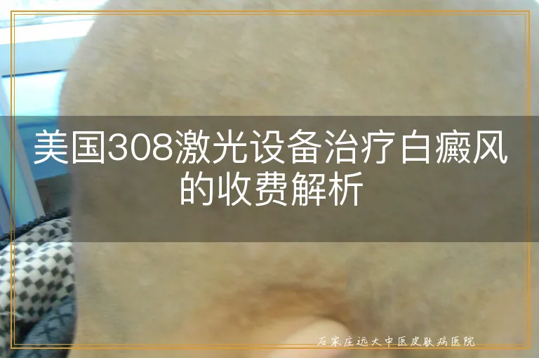 美国308激光设备治疗白癜风的收费解析