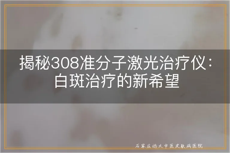 揭秘308准分子激光治疗仪：白斑治疗的新希望