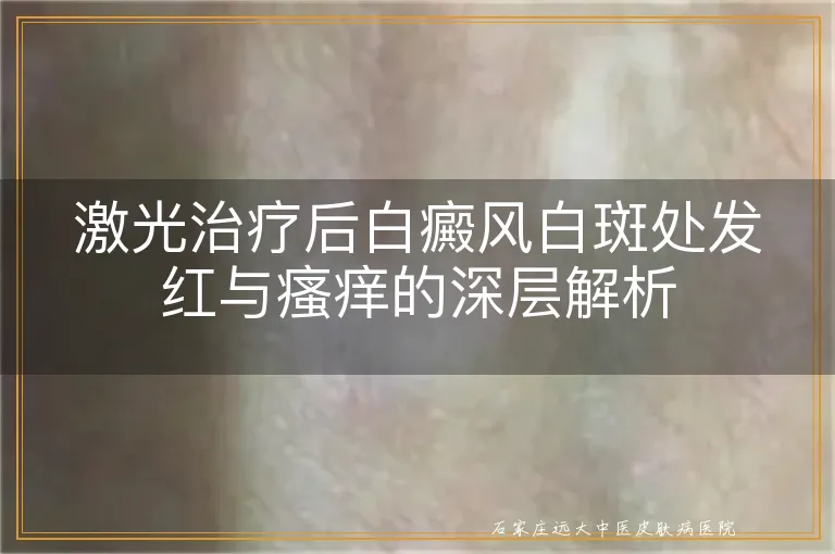 激光治疗后白癜风白斑处发红与瘙痒的深层解析