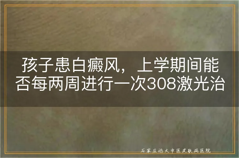 孩子患白癜风，上学期间能否每两周进行一次308激光治疗？