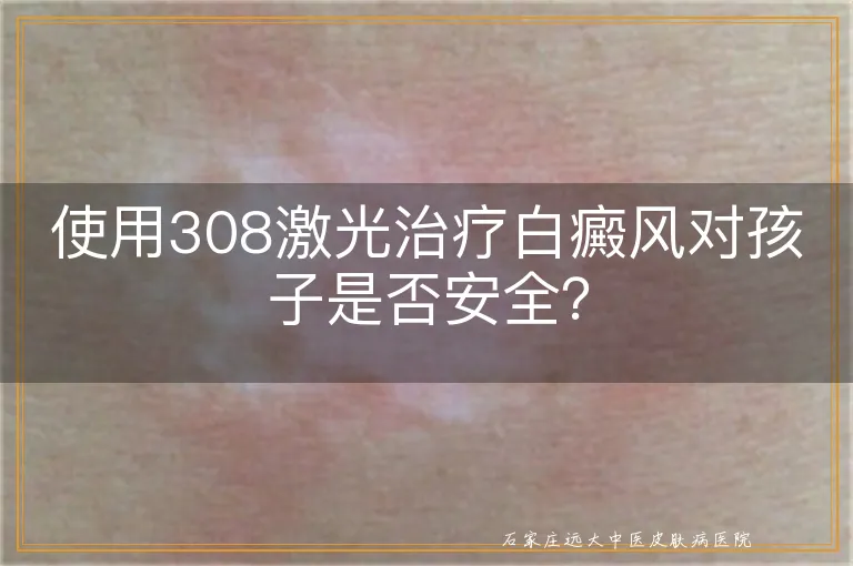 使用308激光治疗白癜风对孩子是否安全？