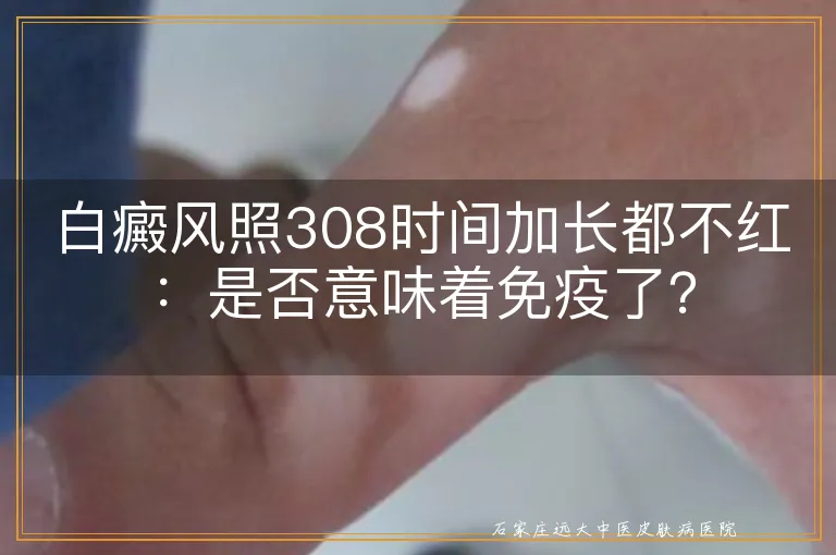 白癜风照308时间加长都不红：是否意味着免疫了？