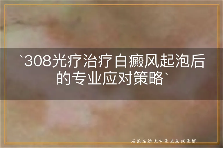 308光疗治疗白癜风起泡后的专业应对策略