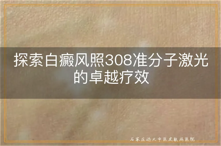 探索白癜风照308准分子激光的卓越疗效