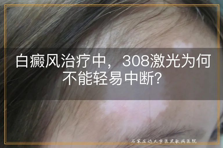 白癜风治疗中，308激光为何不能轻易中断？