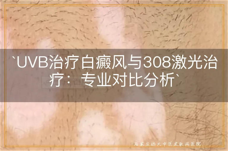 UVB治疗白癜风与308激光治疗：专业对比分析