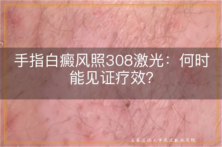 手指白癜风照308激光：何时能见证疗效？