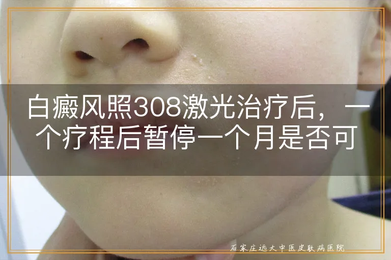 白癜风照308激光治疗后，一个疗程后暂停一个月是否可行？