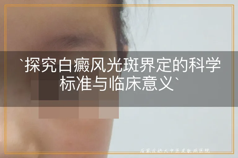 探究白癜风光斑界定的科学标准与临床意义