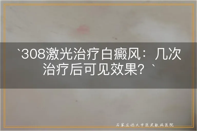 308激光治疗白癜风：几次治疗后可见效果？