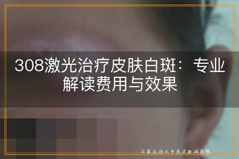 308激光治疗皮肤白斑：专业解读费用与效果