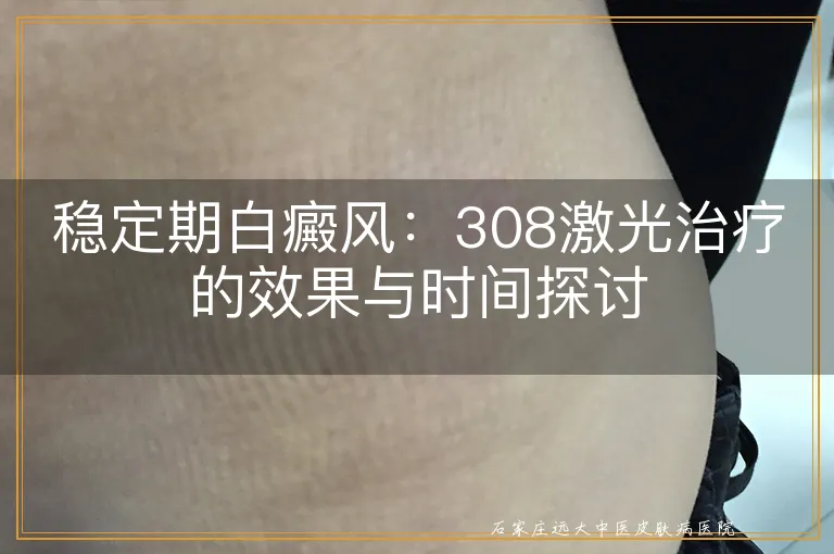 稳定期白癜风：308激光治疗的效果与时间探讨