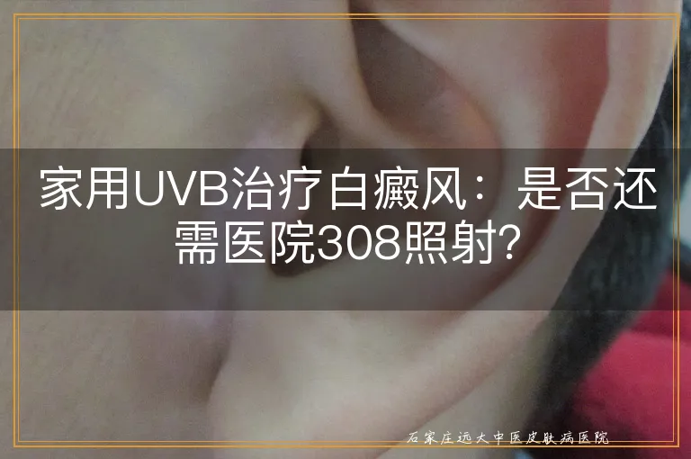 家用UVB治疗白癜风：是否还需医院308照射？