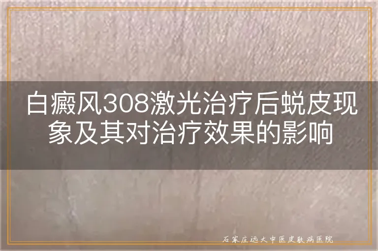 白癜风308激光治疗后蜕皮现象及其对治疗效果的影响