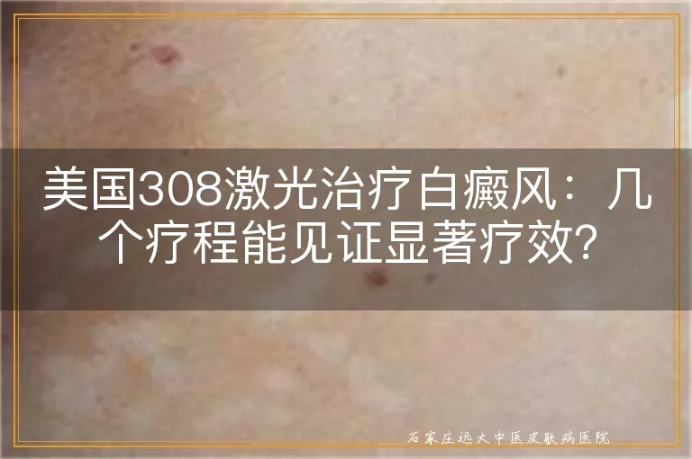 美国308激光治疗白癜风：几个疗程能见证显著疗效？