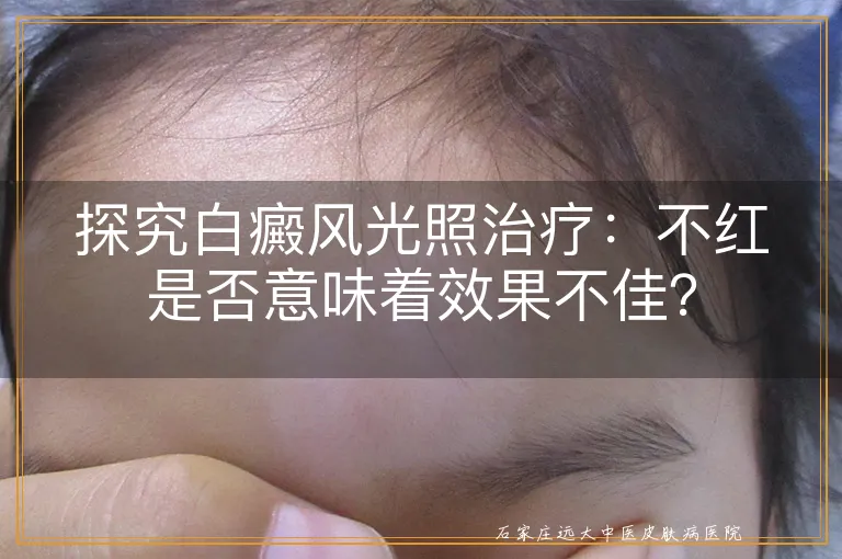 探究白癜风光照治疗：不红是否意味着效果不佳？