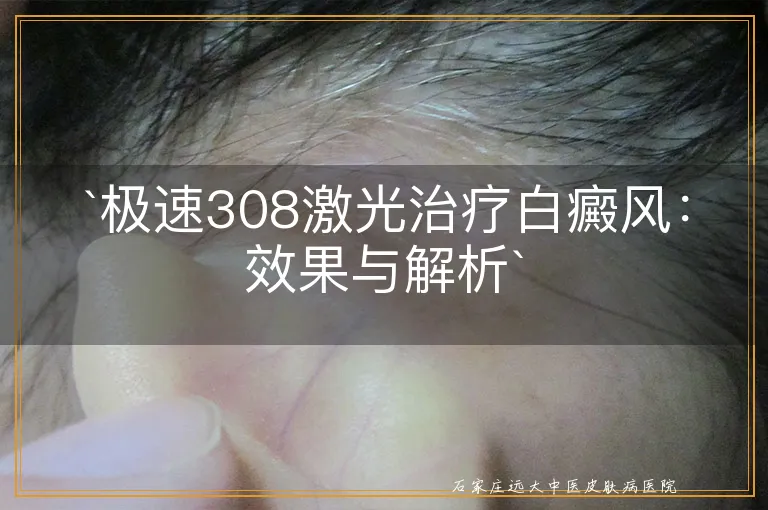 极速308激光治疗白癜风：效果与解析