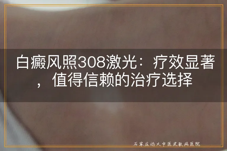 白癜风照308激光：疗效显著，值得信赖的治疗选择