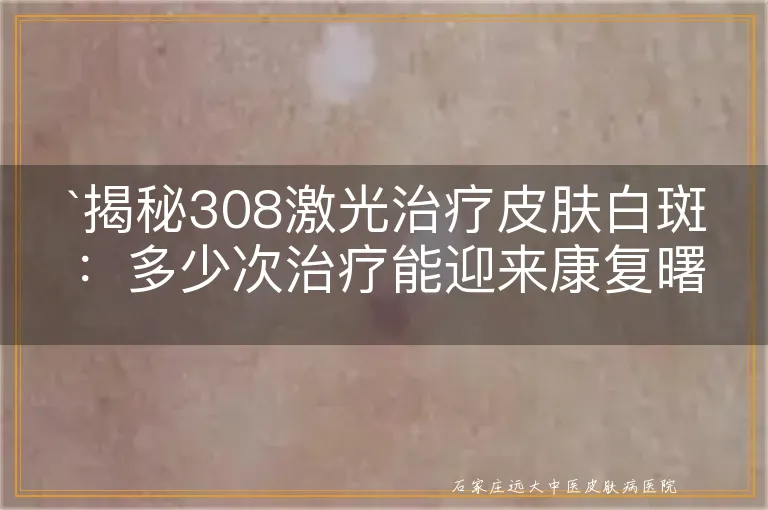 揭秘308激光治疗皮肤白斑：多少次治疗能迎来康复曙光？