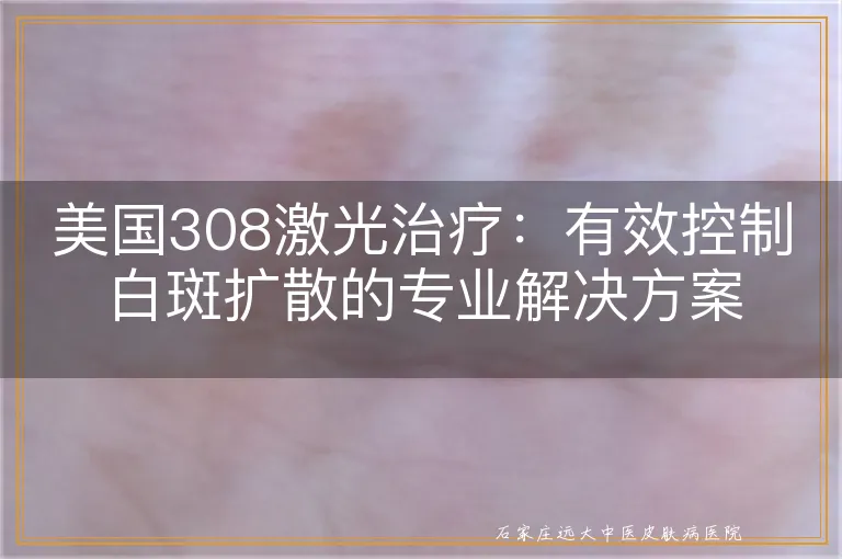 美国308激光治疗：有效控制白斑扩散的专业解决方案