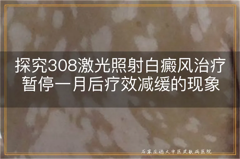 探究308激光照射白癜风治疗暂停一月后疗效减缓的现象