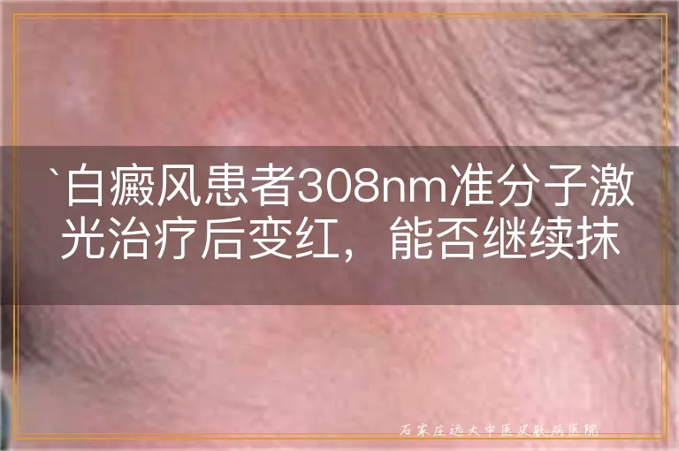 白癜风患者308nm准分子激光治疗后变红，能否继续抹药？