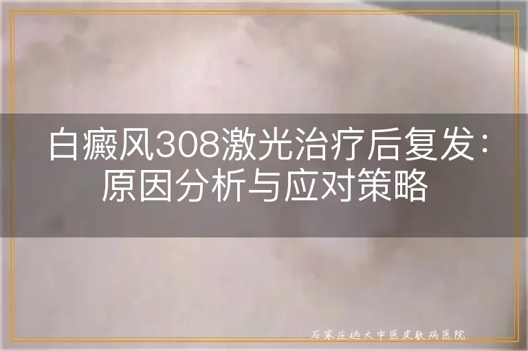 白癜风308激光治疗后复发：原因分析与应对策略