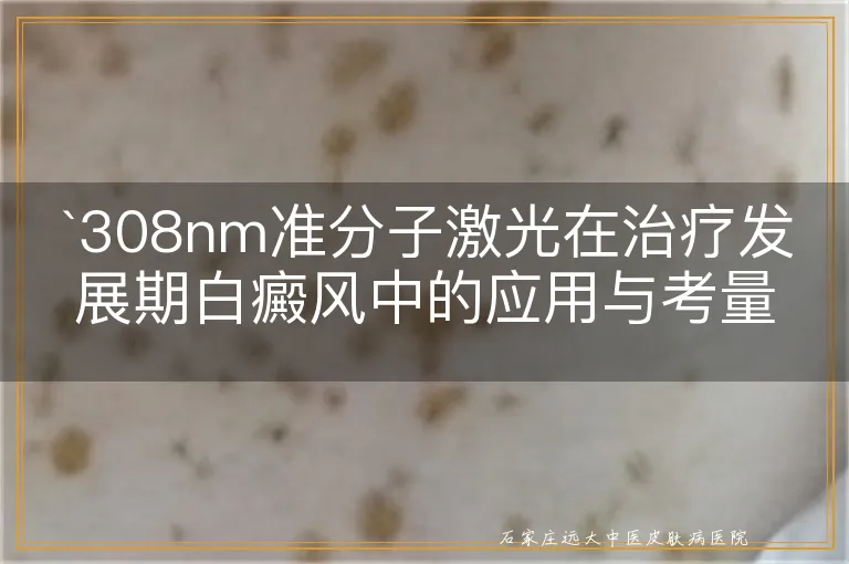 308nm准分子激光在治疗发展期白癜风中的应用与考量