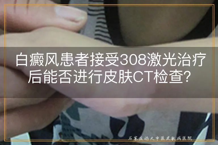 白癜风患者接受308激光治疗后能否进行皮肤CT检查？