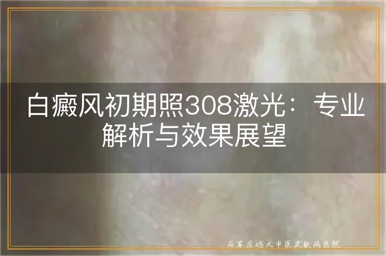 白癜风初期照308激光：专业解析与效果展望