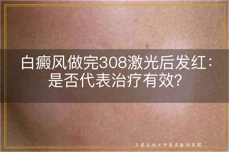 白癜风做完308激光后发红：是否代表治疗有效？