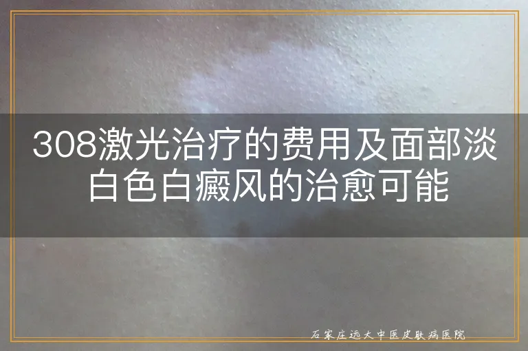 308激光治疗的费用及面部淡白色白癜风的治愈可能