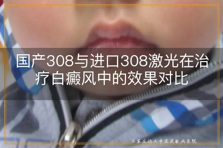 国产308与进口308激光在治疗白癜风中的效果对比