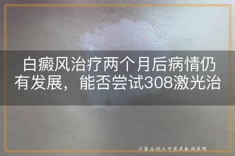 白癜风治疗两个月后病情仍有发展，能否尝试308激光治疗？