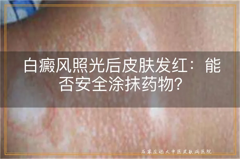 白癜风照光后皮肤发红：能否安全涂抹药物？