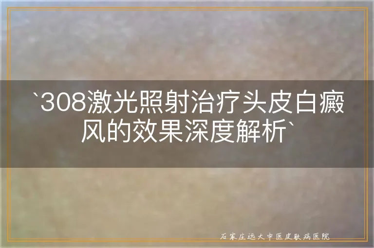 308激光照射治疗头皮白癜风的效果深度解析