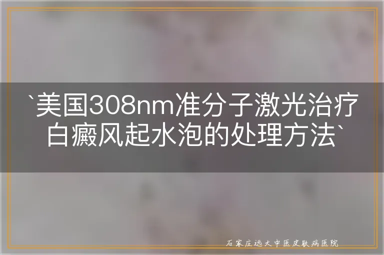 美国308nm准分子激光治疗白癜风起水泡的处理方法