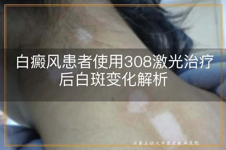 白癜风患者使用308激光治疗后白斑变化解析