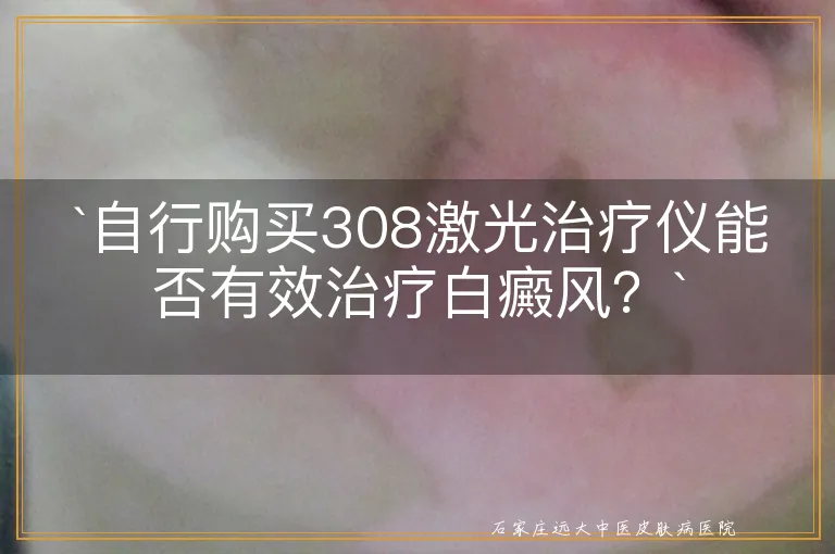 自行购买308激光治疗仪能否有效治疗白癜风？