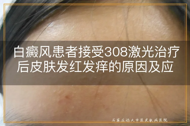 白癜风患者接受308激光治疗后皮肤发红发痒的原因及应对