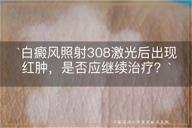 白癜风照射308激光后出现红肿，是否应继续治疗？