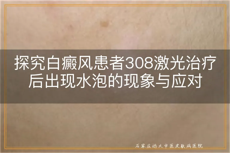 探究白癜风患者308激光治疗后出现水泡的现象与应对