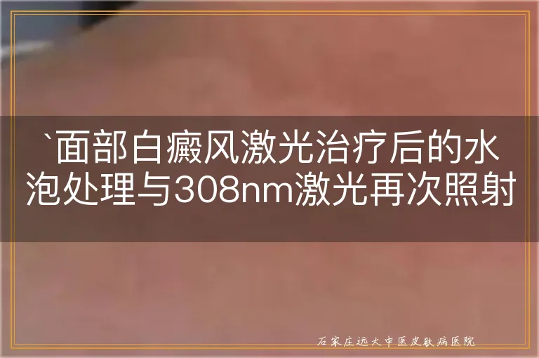 面部白癜风激光治疗后的水泡处理与308nm激光再次照射时机探讨