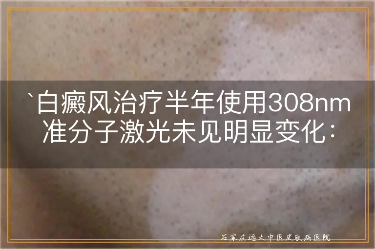 白癜风治疗半年使用308nm准分子激光未见明显变化：是否应调整治疗策略？