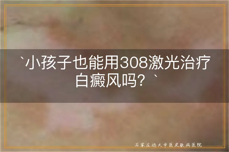 小孩子也能用308激光治疗白癜风吗？